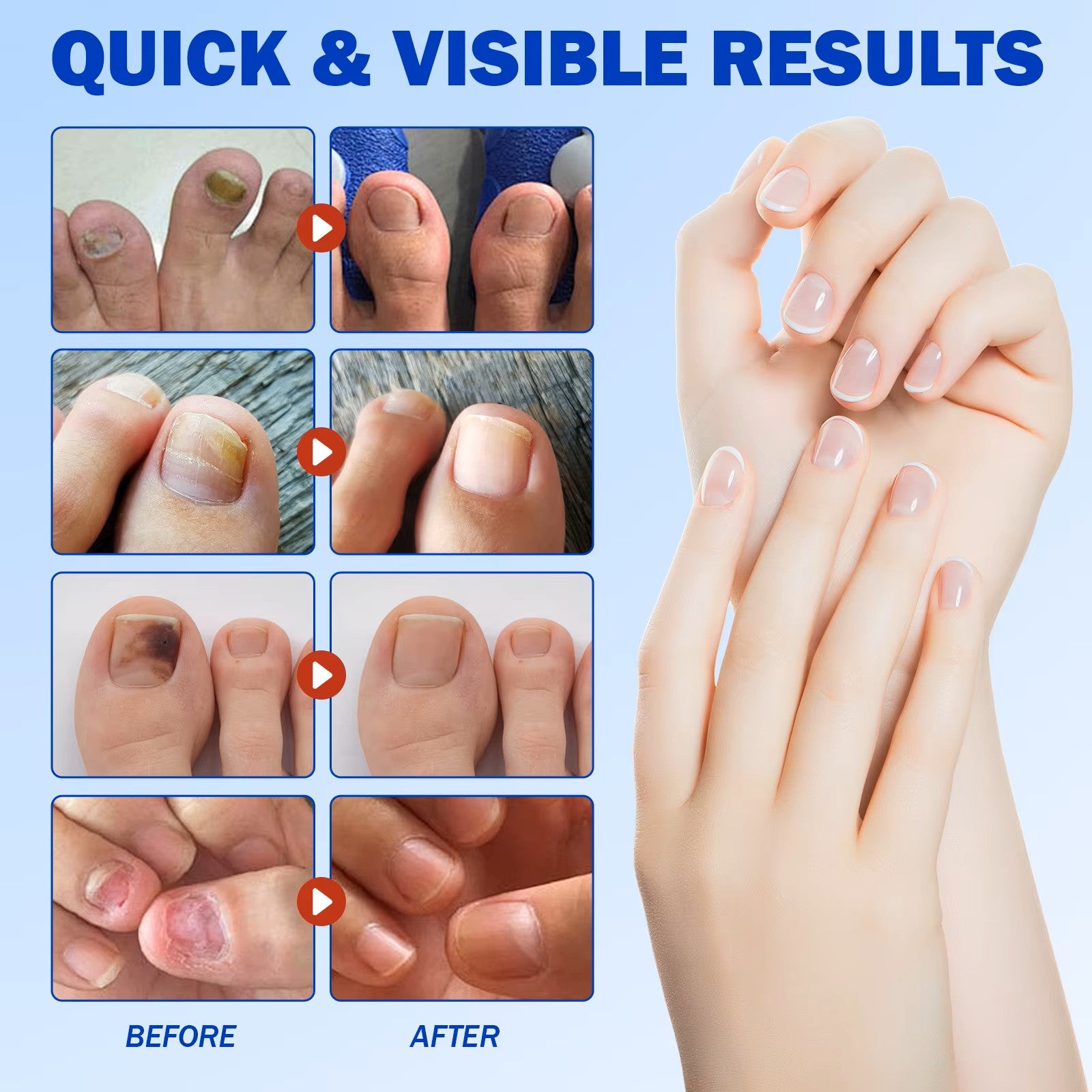 Plasturi pentru ciuperca unghiei